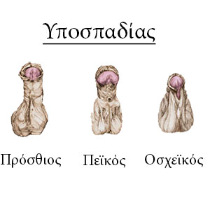 Hypospadias